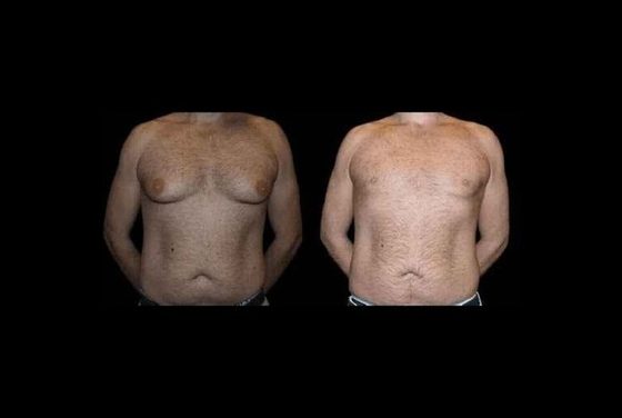 Before and After Male Breast Reduction Surgery